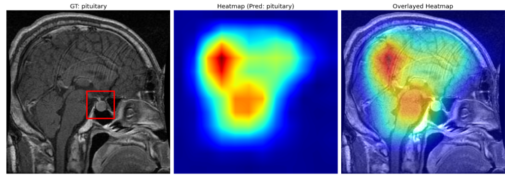 GradCAM visualization on a pituitary tumor