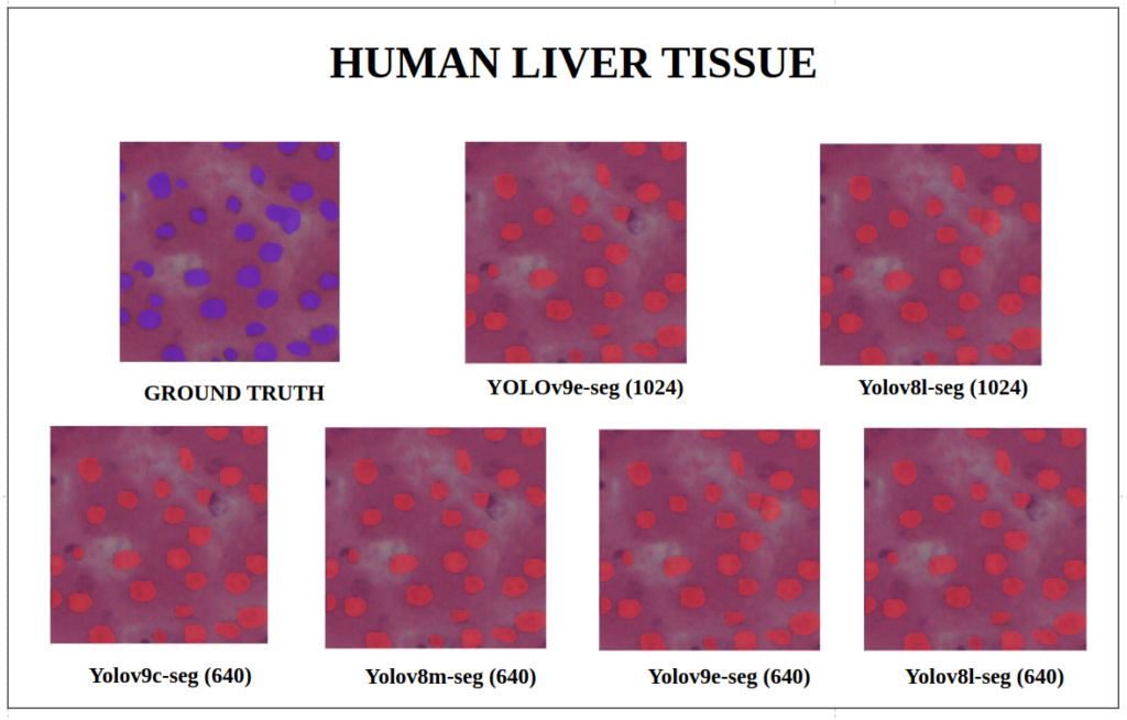 yolov9 instance segmentation -Human Liver Tissue - YOLOv9-seg v/s YOLOv8-seg Instance Segmentation