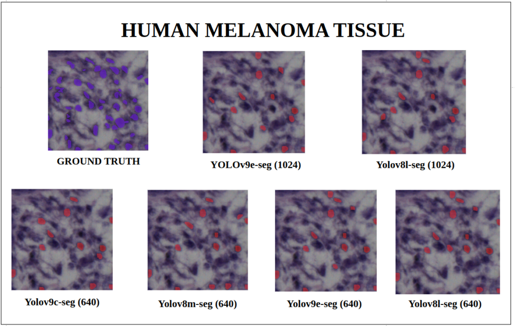 yolov9 instance segmentation - Human Melanoma Tissue - YOLOv9-seg v/s YOLOv8-seg Instance Segmentation