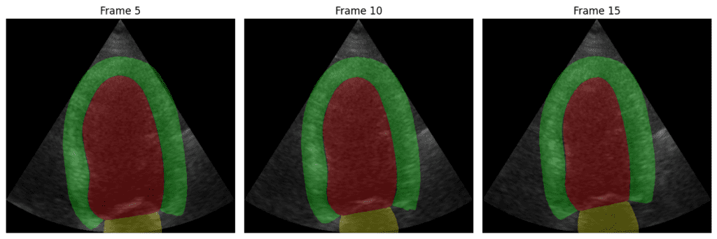 medsam2 inference result - Cardiac Ultrasound (Echo) Segmentation
