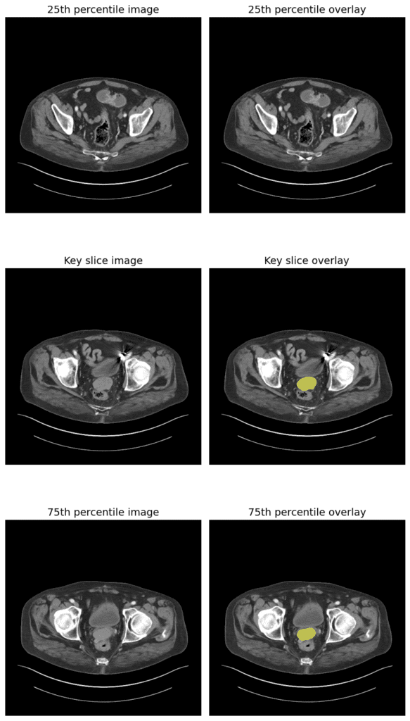 medsam2 inference result - 3D CT Segmentation of Pelvic Lesion