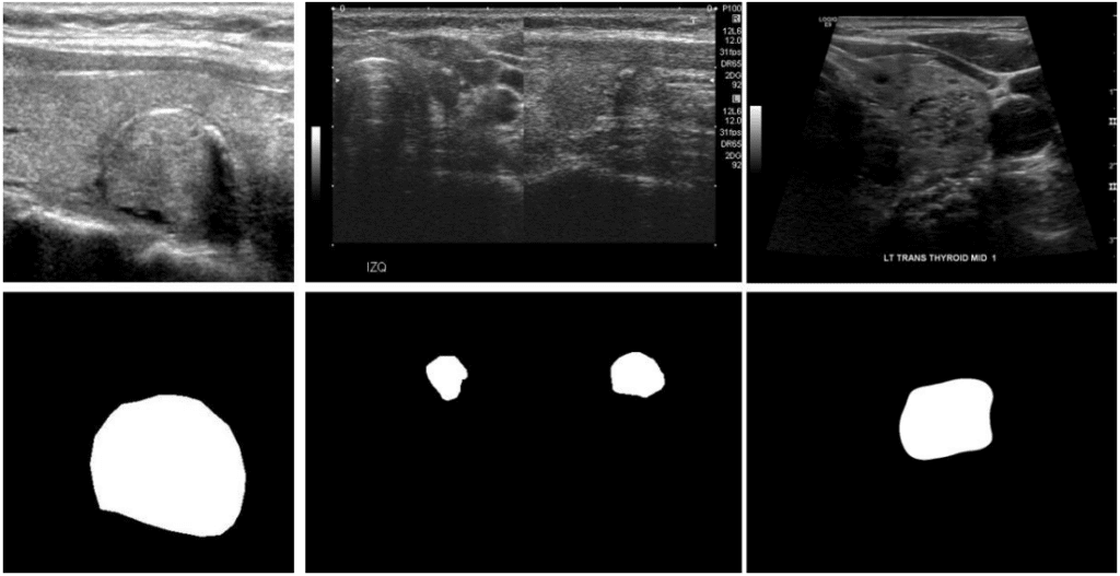 A set of three grayscale ultrasound images in the top row showing thyroid nodules from the TN3K dataset, paired with their corresponding binary segmentation masks in the bottom row. The masks highlight pixel-level annotations used for training and evaluating AnomalyCLIP. This visualization illustrates the dataset’s support for pixel-wise anomaly supervision, critical for measuring performance using AUPRO and pixel-level AUROC.